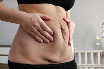 Diastasis recti, avagy sz&eacute;tny&iacute;lt hasizom sz&uuml;l&eacute;s ut&aacute;n - gy&oacute;gytorn&aacute;sz szemmel